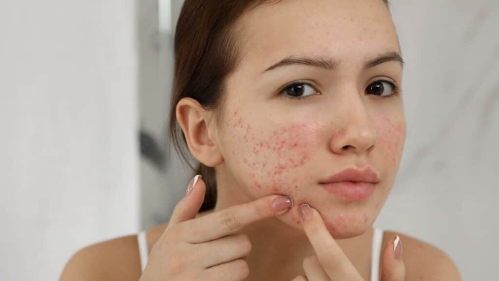Người đang bị viêm chống chỉ định với công nghệ làm đẹp HIFU